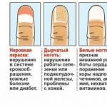 Почему ногти становятся волнистыми на пальцах рук